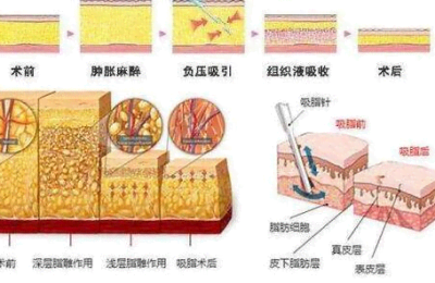 吸脂减肥的危害  