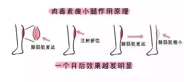 抽脂可以瘦腿吗 