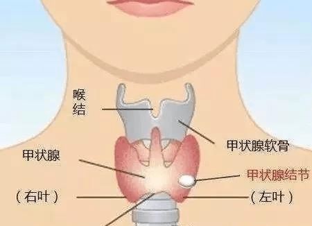 甲状腺有结节导致失眠 